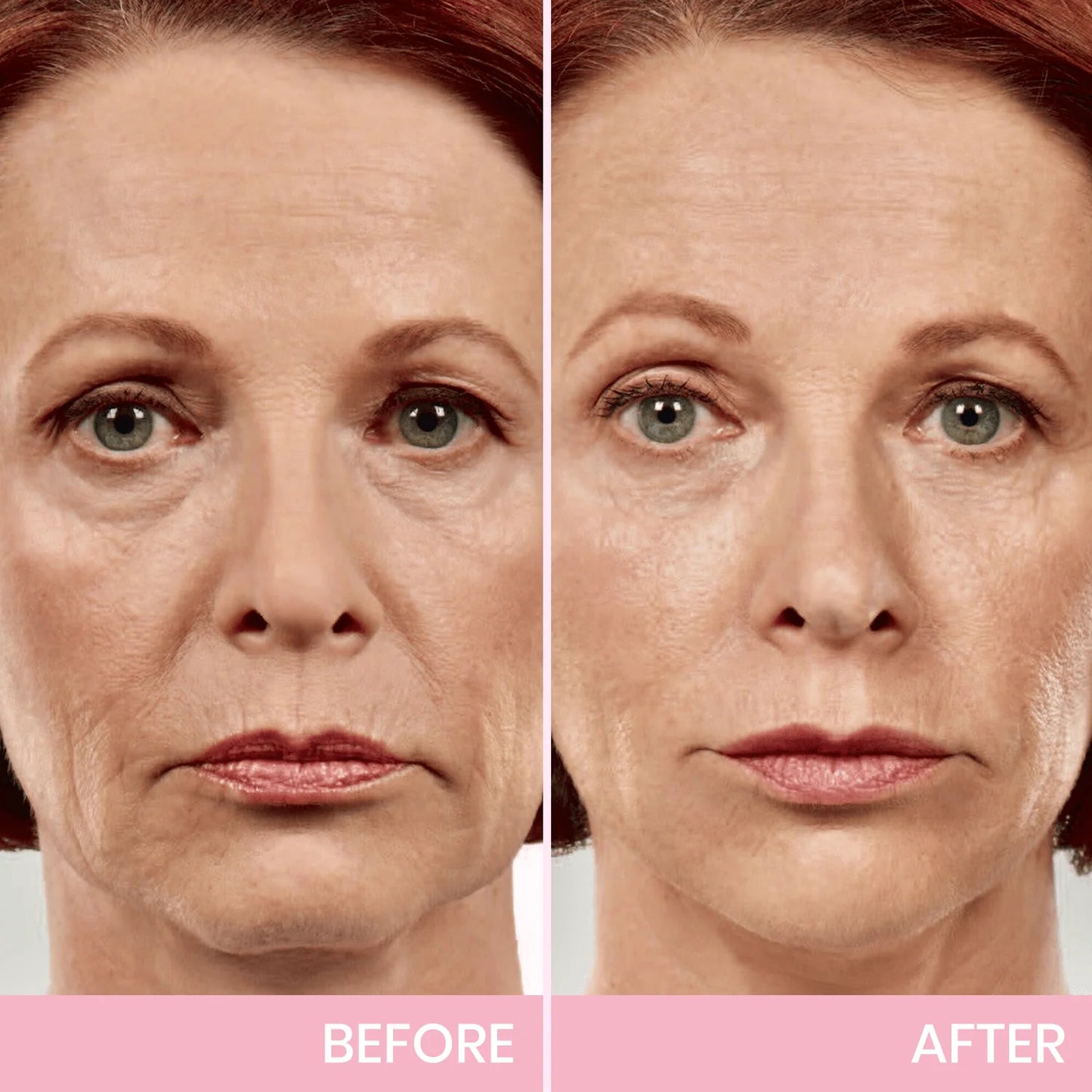 InvisiLift™ | Invisible Adhesive Tape for Facial Lifting