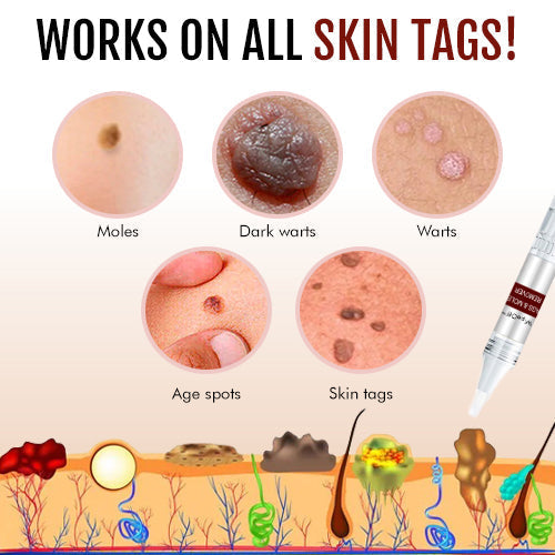 ClearMole™ | Remove Skin Tags & Moles